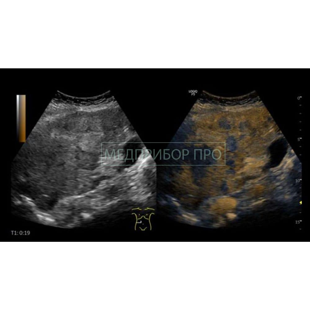 GE Healthcare Logiq P9 - ультразвуковая система GE Healthcare Logiq P9 - ультразвуковая система