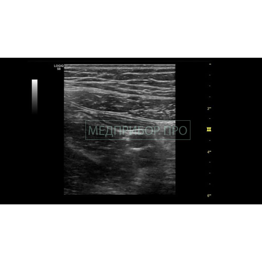 GE Healthcare Logiq S8 XDclear 2.0 - ультразвуковая система GE Healthcare Logiq S8 XDclear 2.0 - ультразвуковая система