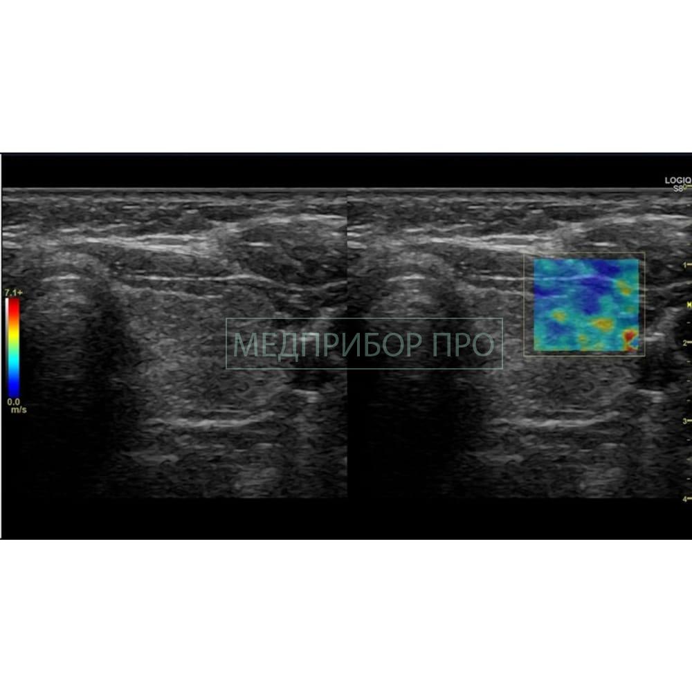 GE Healthcare Logiq S8 XDclear 2.0 - ультразвуковая система GE Healthcare Logiq S8 XDclear 2.0 - ультразвуковая система
