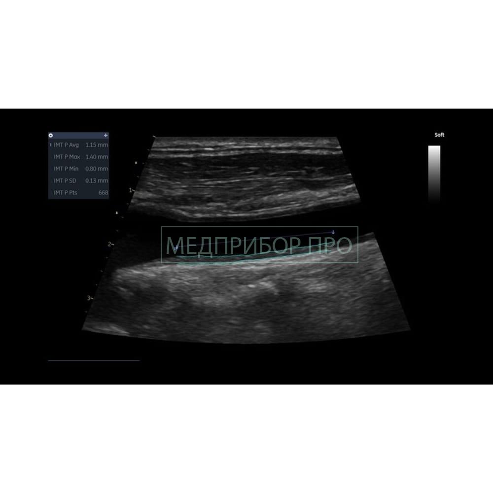 GE Healthcare Vivid IQ - ультразвуковая система. GE Healthcare Vivid IQ - ультразвуковая система