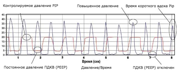 График работы Neopuff