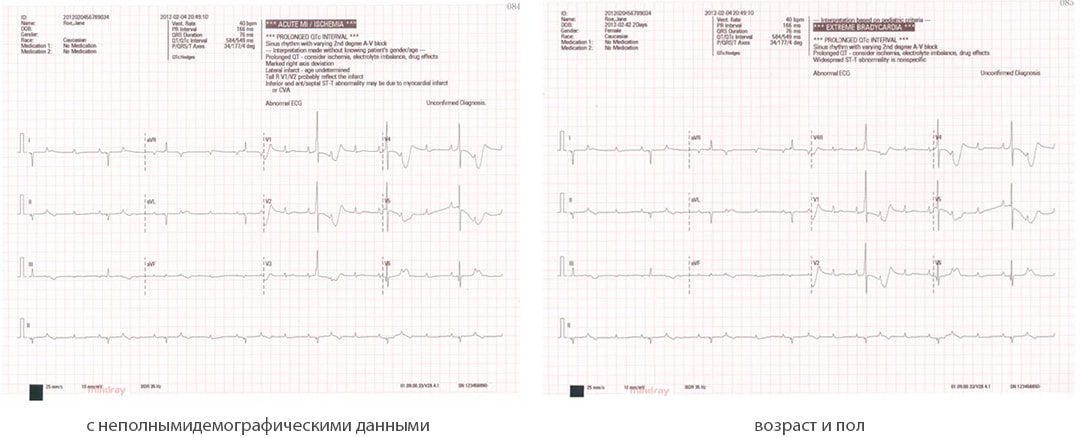 Клиническое использование BeneHeart R12 в больнице