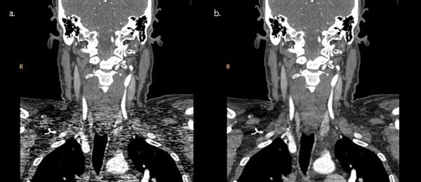 Работа iDose4 в Ingenuity Elite 128